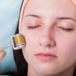 Benefits and Side Effects of Microneedling